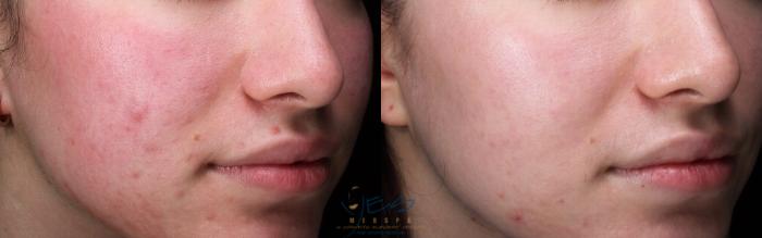 Before & After Skin Care Programs & Chemical Peels Case 417 Right Oblique View in Vancouver, BC