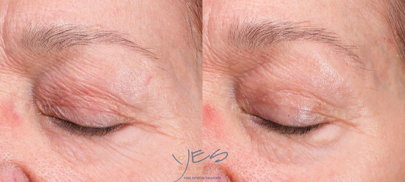 Before & After Skin Care Programs & Chemical Peels Case 419 Left Oblique View in Vancouver, BC
