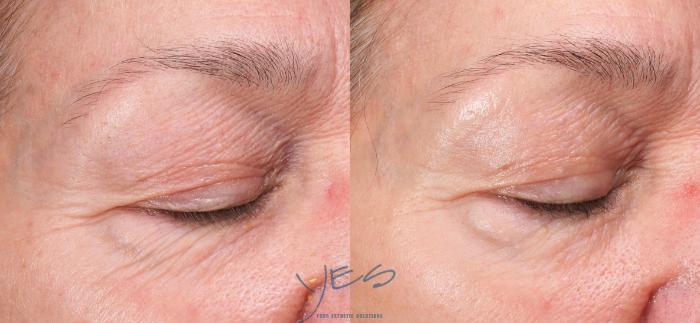 Before & After Skin Care Programs & Chemical Peels Case 419 Right Oblique View in Vancouver, BC
