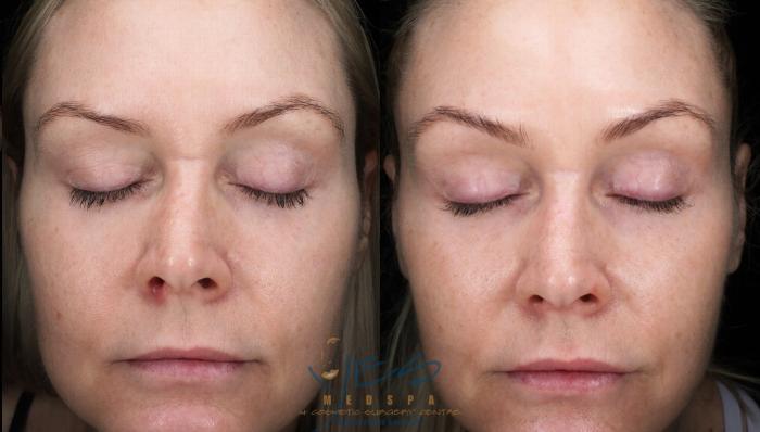 Before & After Skin Care Programs & Chemical Peels Case 422 Front View in Vancouver, BC