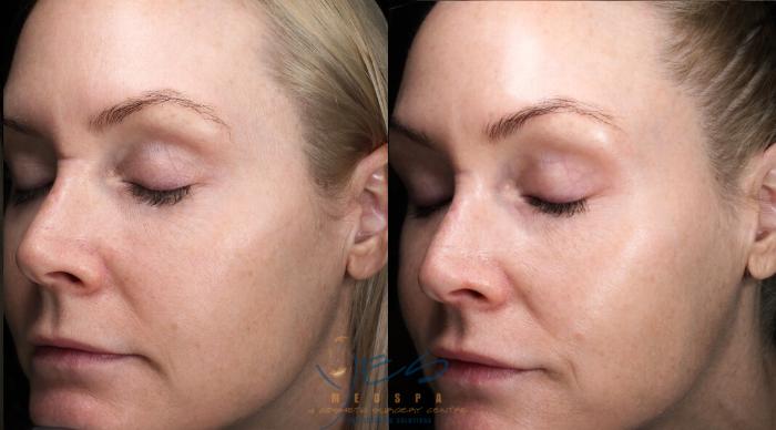 Before & After Skin Care Programs & Chemical Peels Case 422 Left Oblique View in Vancouver, BC