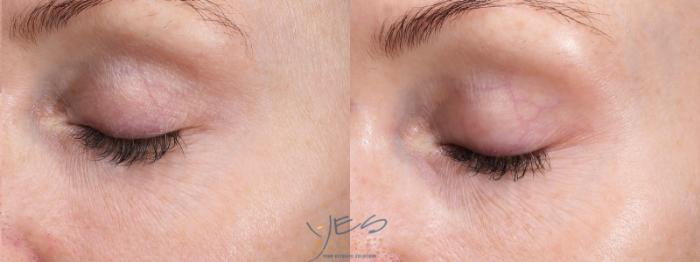 Before & After Skin Care Programs & Chemical Peels Case 422 Left Side View in Vancouver, BC