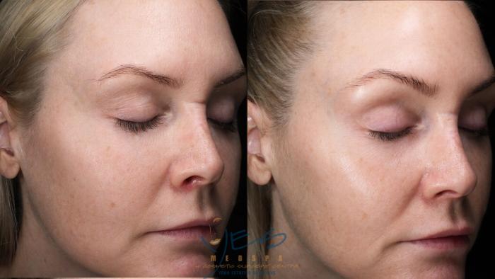 Before & After Skin Care Programs & Chemical Peels Case 422 Right Oblique View in Vancouver, BC