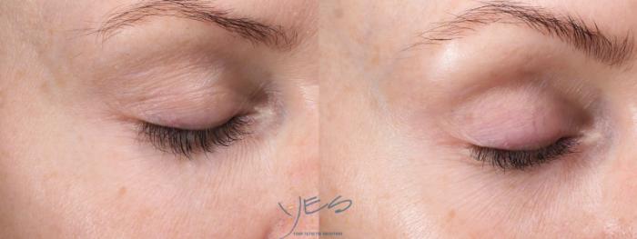 Before & After Skin Care Programs & Chemical Peels Case 422 Right Side View in Vancouver, BC