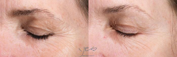 Before & After Skin Care Programs & Chemical Peels Case 424 Left Oblique View in Vancouver, BC