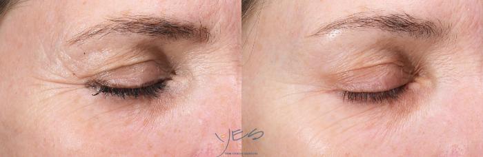 Before & After Skin Care Programs & Chemical Peels Case 424 Right Oblique View in Vancouver, BC