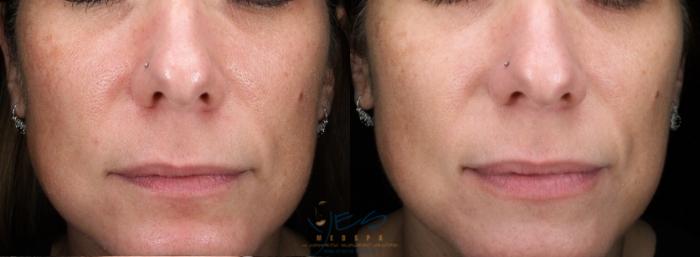 Before & After Skin Care Programs & Chemical Peels Case 463 Front View in Vancouver, BC