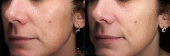 Before & After Skin Care Programs & Chemical Peels Case 463 Left Oblique View in Vancouver, BC