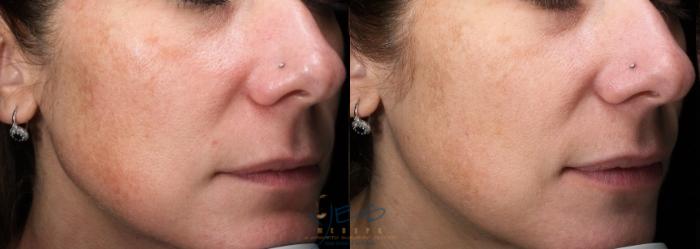 Before & After Skin Care Programs & Chemical Peels Case 463 Right Oblique View in Vancouver, BC