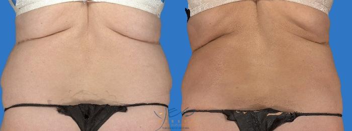Before & After SmartLipo™ Case 118 Back View in Vancouver, BC