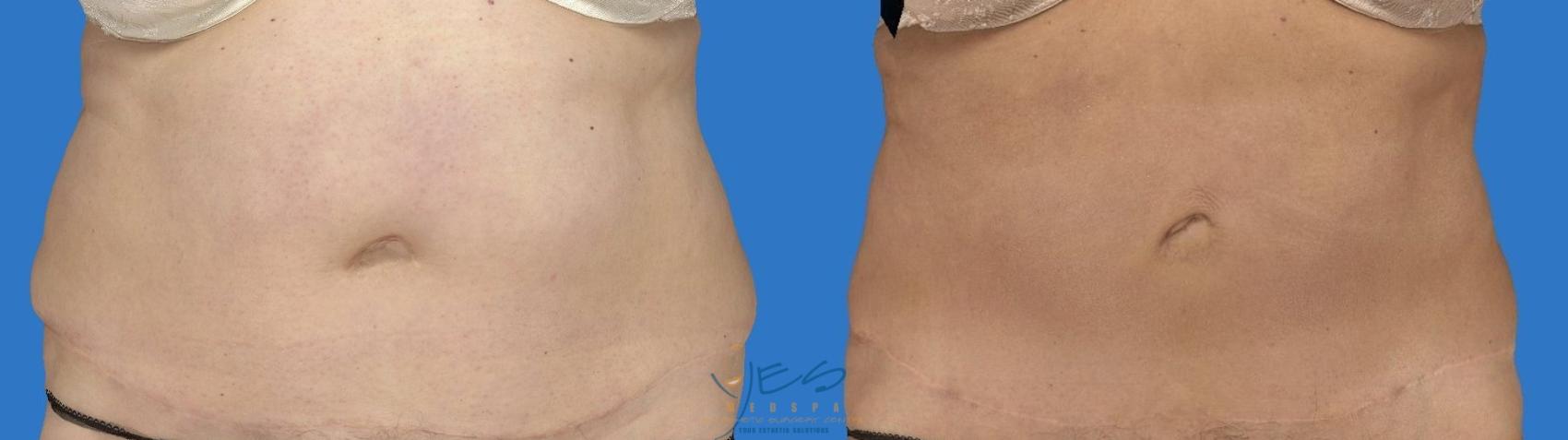 Before & After SmartLipo™ Case 118 Front View in Vancouver, BC