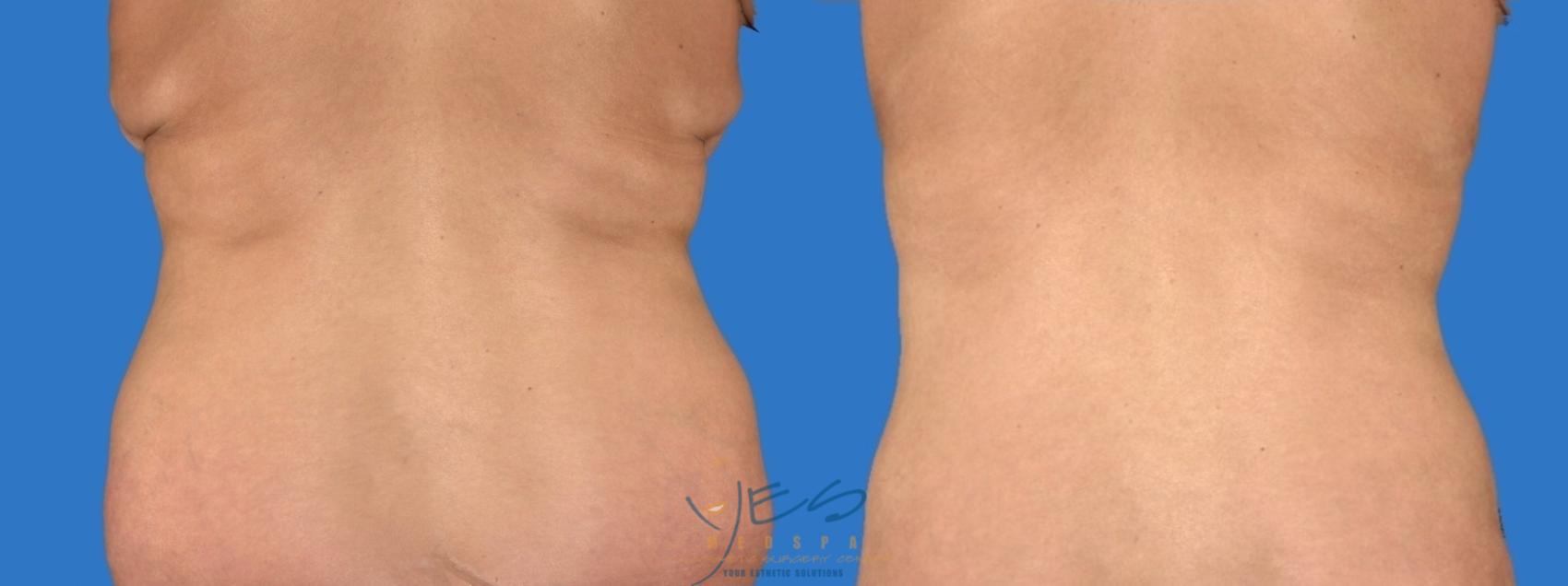 Before & After SmartLipo™ Case 125 Back View in Vancouver, BC