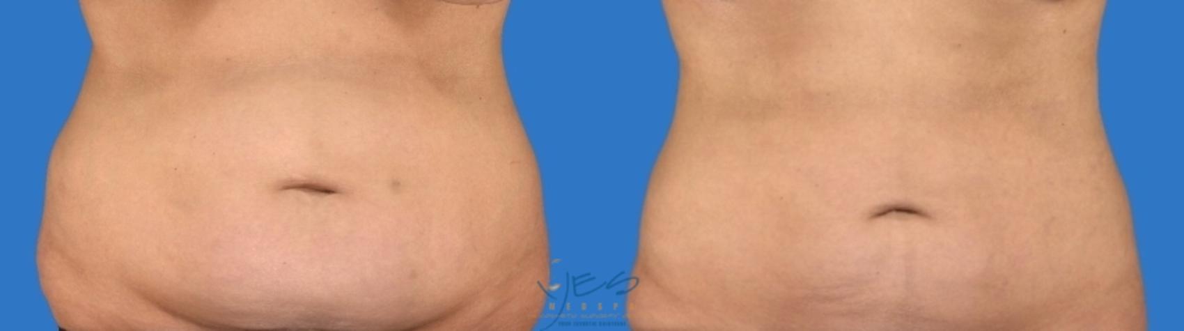 Before & After SmartLipo™ Case 125 Front View in Vancouver, BC