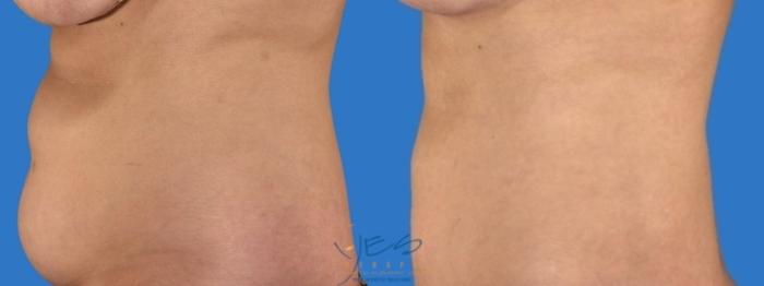 Before & After SmartLipo™ Case 125 Left Side View in Vancouver, BC