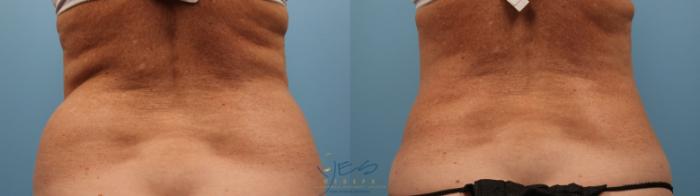 Before & After SmartLipo™ Case 136 Back View in Vancouver, BC