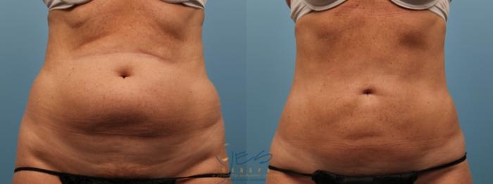 Before & After SmartLipo™ Case 136 Front View in Vancouver, BC