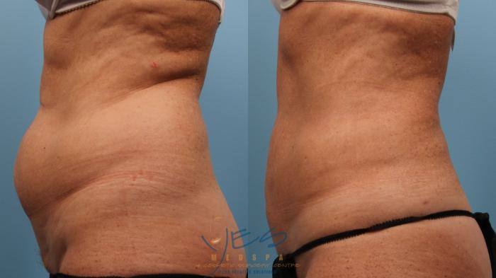 Before & After SmartLipo™ Case 136 Left Side View in Vancouver, BC