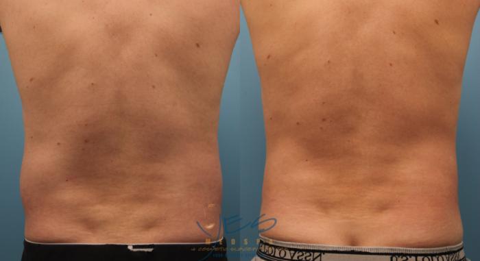 Before & After SmartLipo™ Case 149 Back View in Vancouver, BC