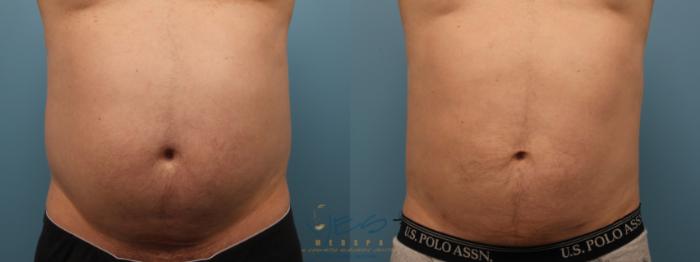 Before & After SmartLipo™ Case 149 Front View in Vancouver, BC