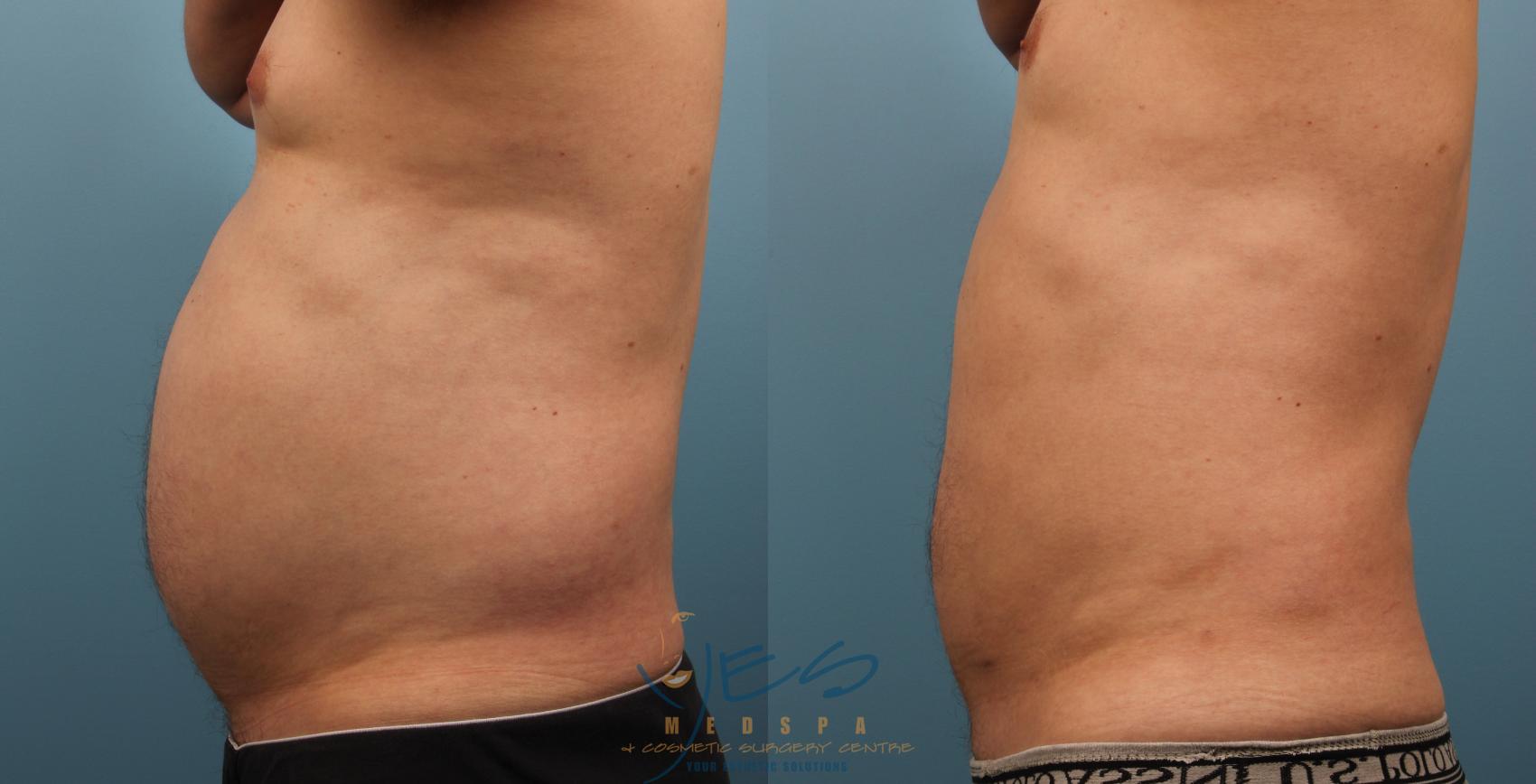 Before & After SmartLipo™ Case 149 Left Side View in Vancouver, BC