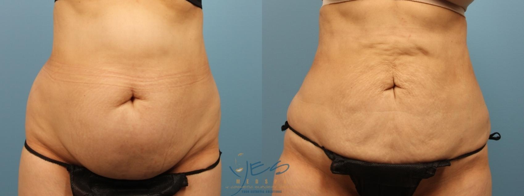 Before & After SmartLipo™ Case 175 Front View in Vancouver, BC