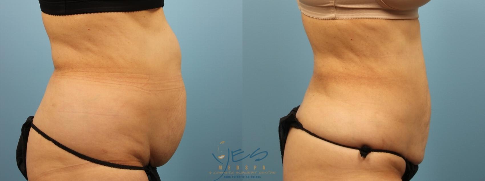 Before & After SmartLipo™ Case 175 Right Side View in Vancouver, BC