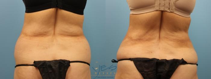 Before & After SmartLipo™ Case 175 View #3 View in Vancouver, BC