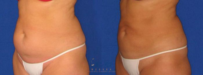 Before & After SmartLipo™ Case 22 Left Oblique View in Vancouver, BC