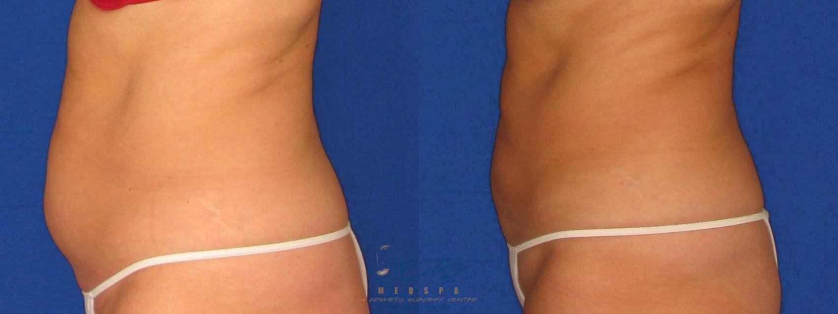 Before & After SmartLipo™ Case 22 Left Side View in Vancouver, BC