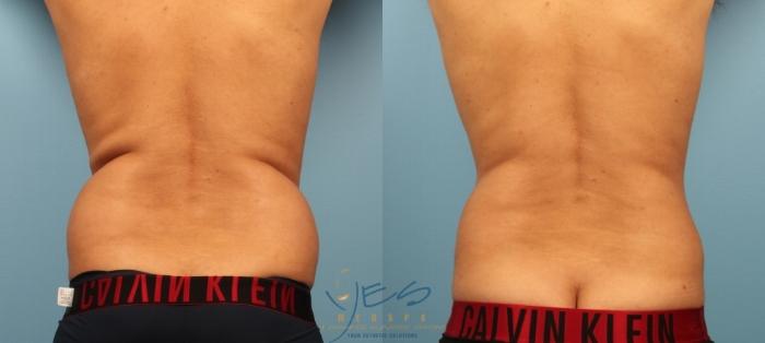 Before & After Liposuction Case 456 Back View in Vancouver, BC