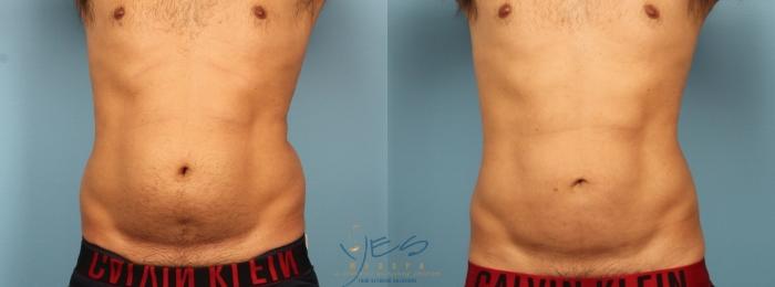 Before & After Liposuction Case 456 Front View in Vancouver, BC