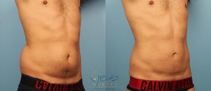 Before & After Liposuction Case 456 Right Oblique View in Vancouver, BC