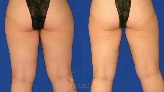 Before & After SmartLipo™ Case 76 Back View in Vancouver, BC