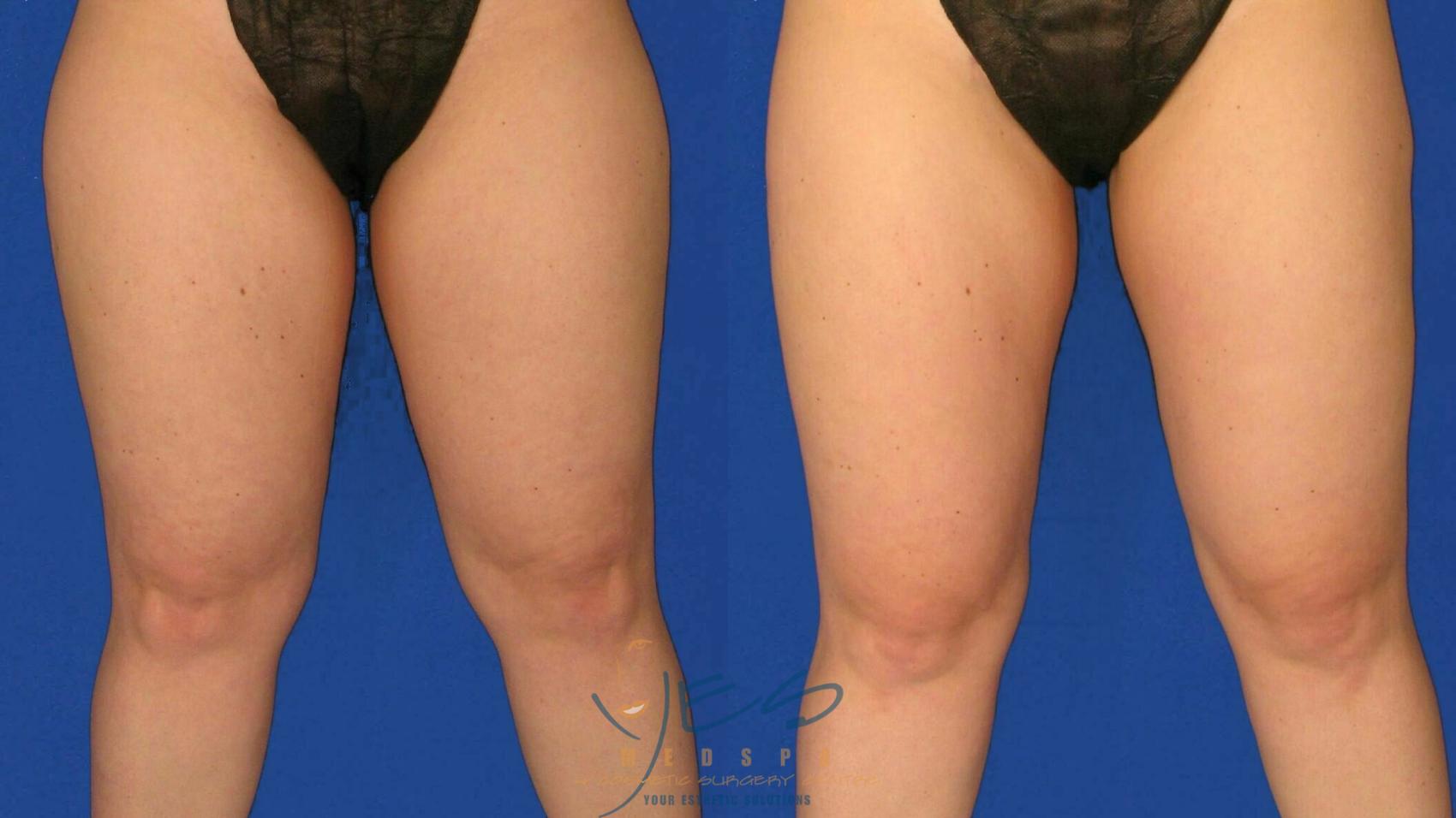Before & After SmartLipo™ Case 76 Front View in Vancouver, BC