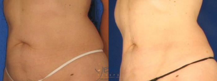 Before & After SmartLipo™ Case 95 Left Oblique View in Vancouver, BC