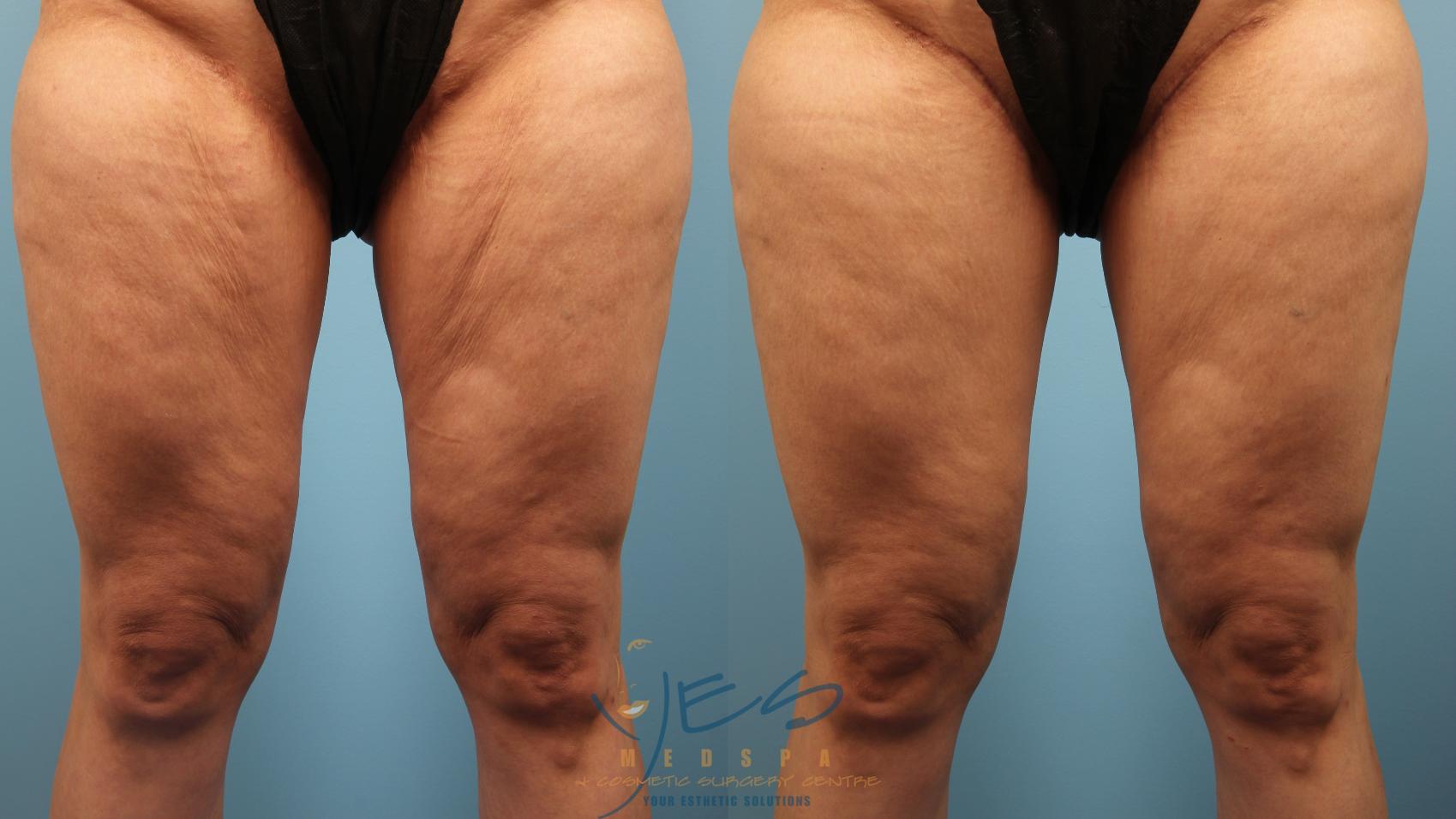 Before & After Cellulaze Case 386 Front View in Vancouver, BC