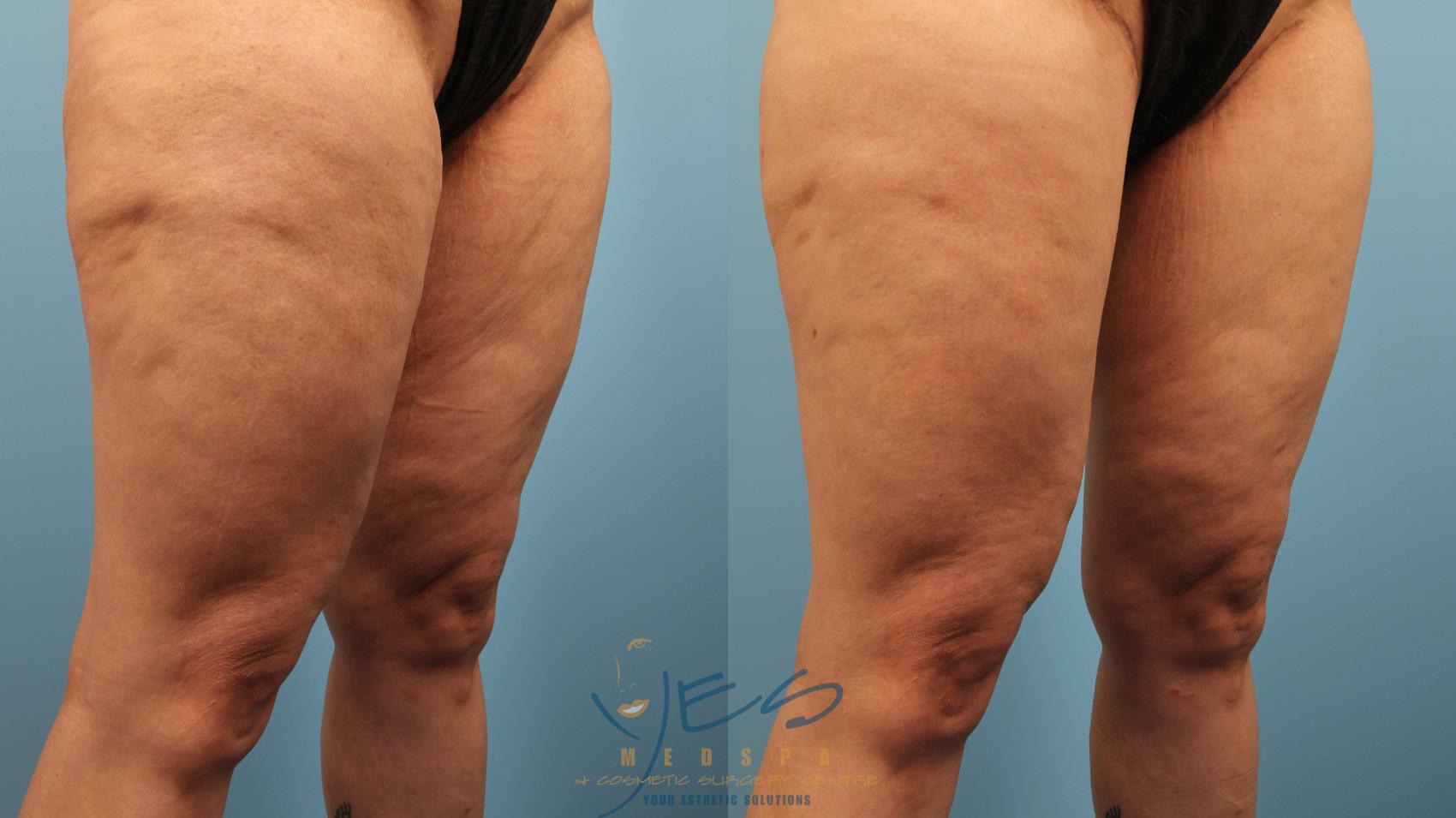 Before & After Cellulaze Case 386 Left Oblique View in Vancouver, BC