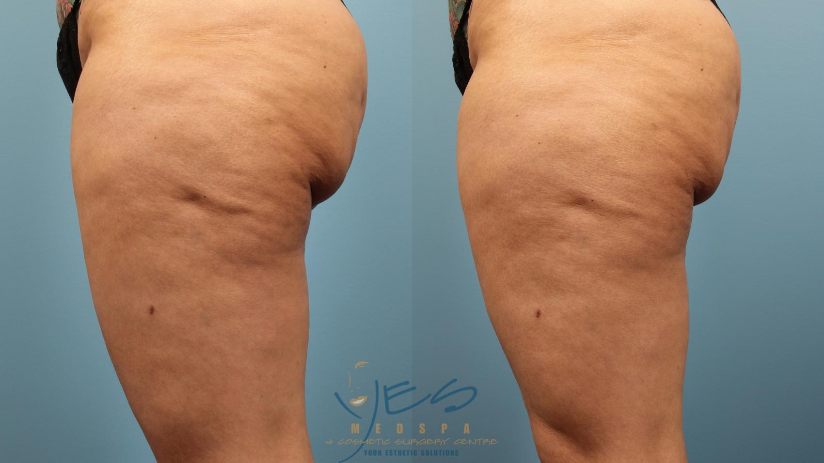 Before & After Cellulaze Case 386 Left Side View in Vancouver, BC