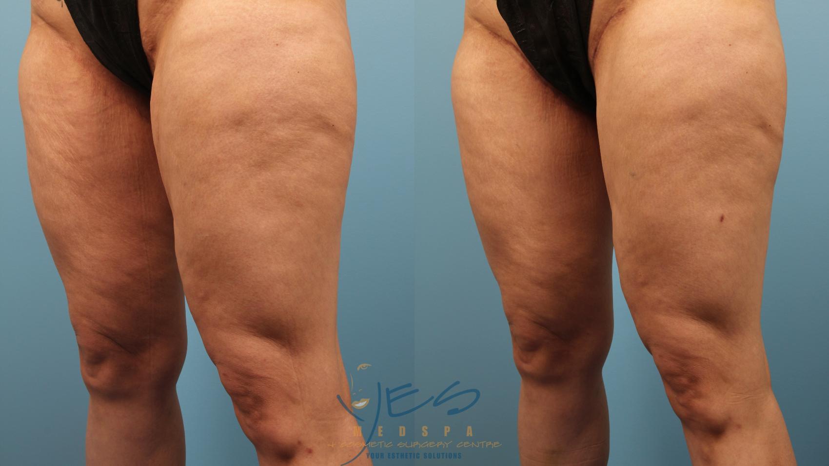 Before & After Cellulaze Case 386 Right Oblique View in Vancouver, BC