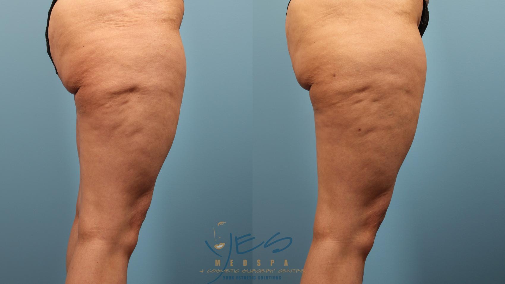 Before & After Cellulaze Case 386 Right Side View in Vancouver, BC