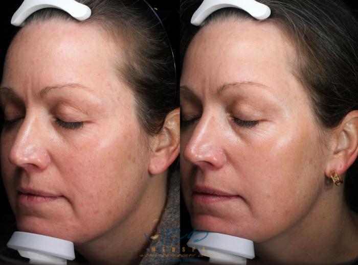 Before & After Skin Care Programs & Chemical Peels Case 364 Left Side View in Vancouver, BC