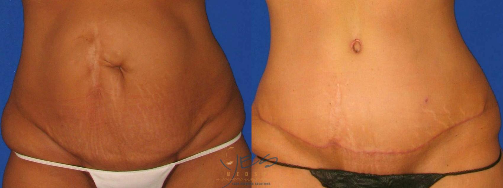 Before & After Tummy Tuck Case 103 Front View in Vancouver, BC