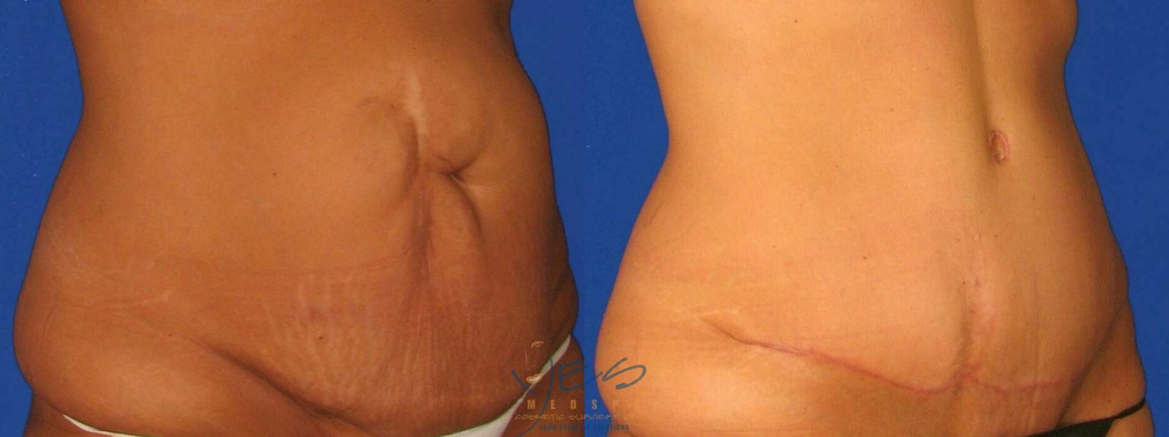 Before & After Tummy Tuck Case 103 Right Oblique View in Vancouver, BC