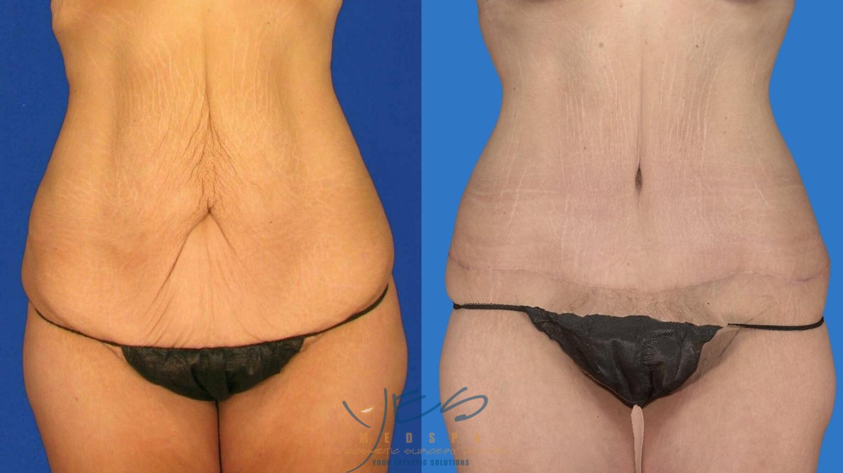 Before & After Tummy Tuck Case 124 Front View in Vancouver, BC