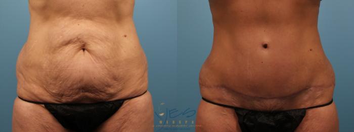 Before & After Tummy Tuck Case 135 Front View in Vancouver, BC
