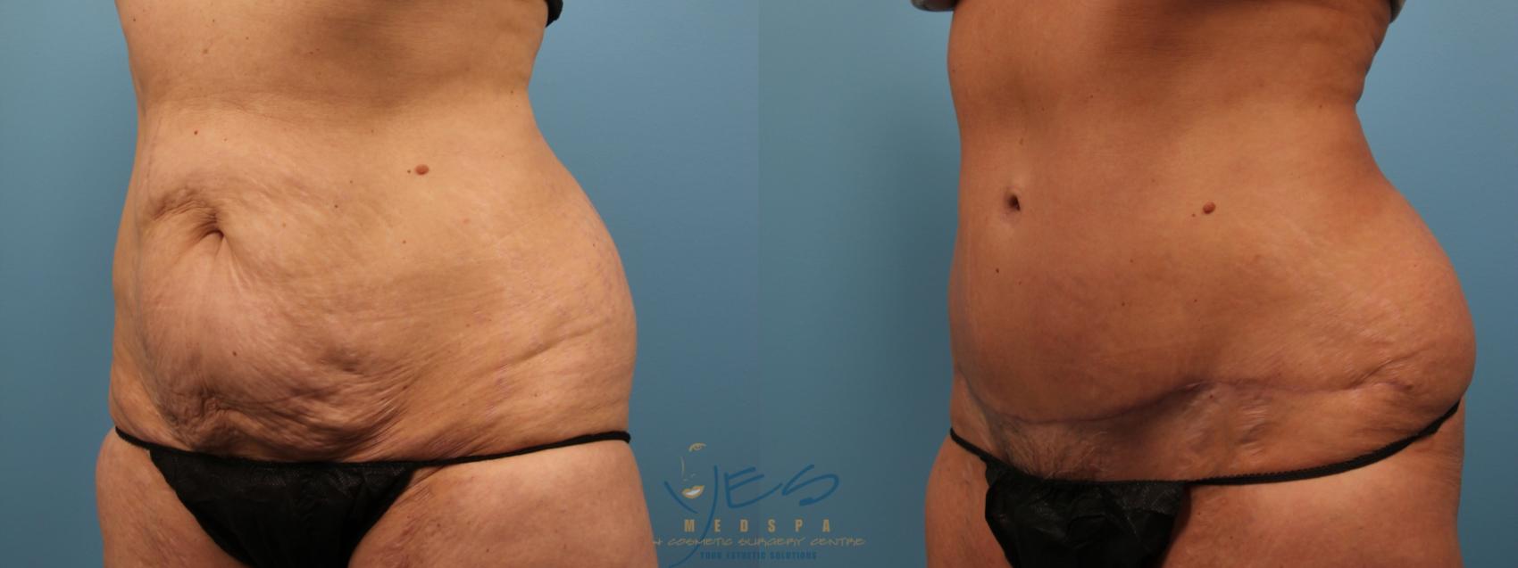 Before & After Tummy Tuck Case 135 Left Oblique View in Vancouver, BC