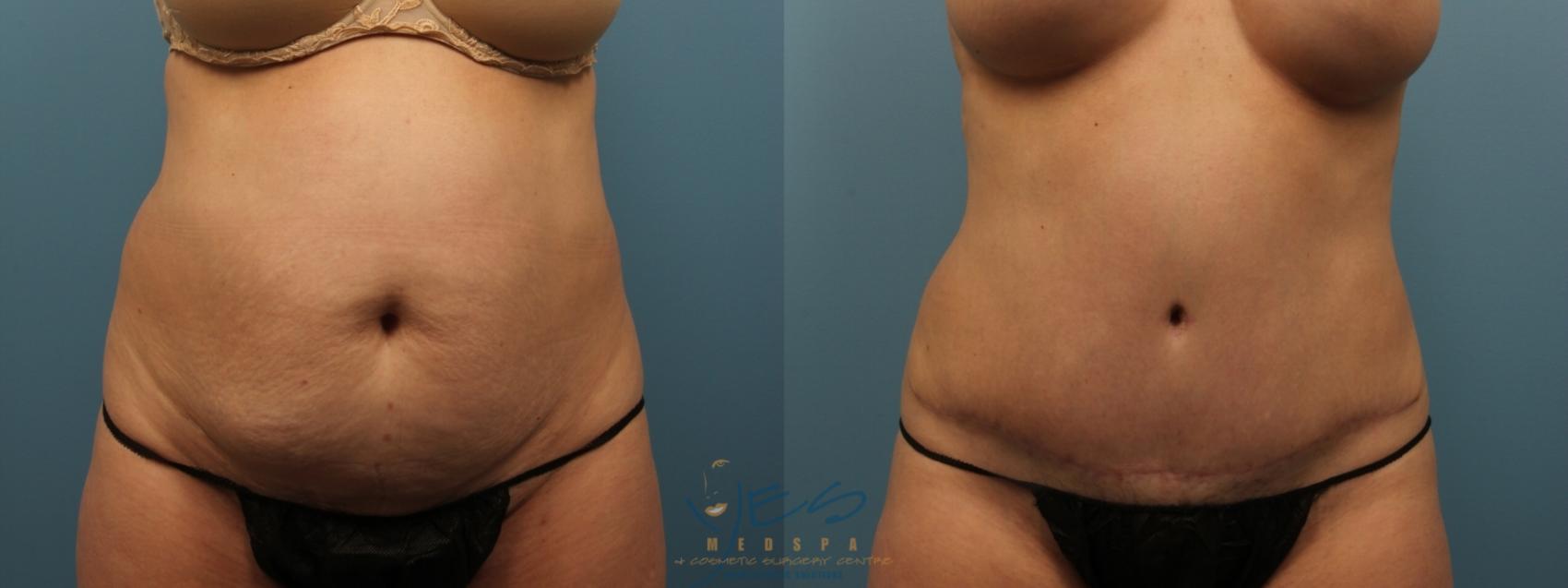 Tummy Tuck in Vancouver, Abdominoplasty