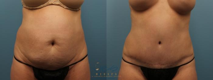 Before & After Tummy Tuck Case 151 Front View in Vancouver, BC