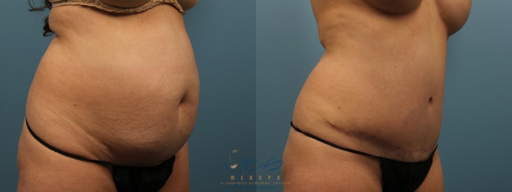 Before & After Tummy Tuck Case 151 Right Oblique View in Vancouver, BC