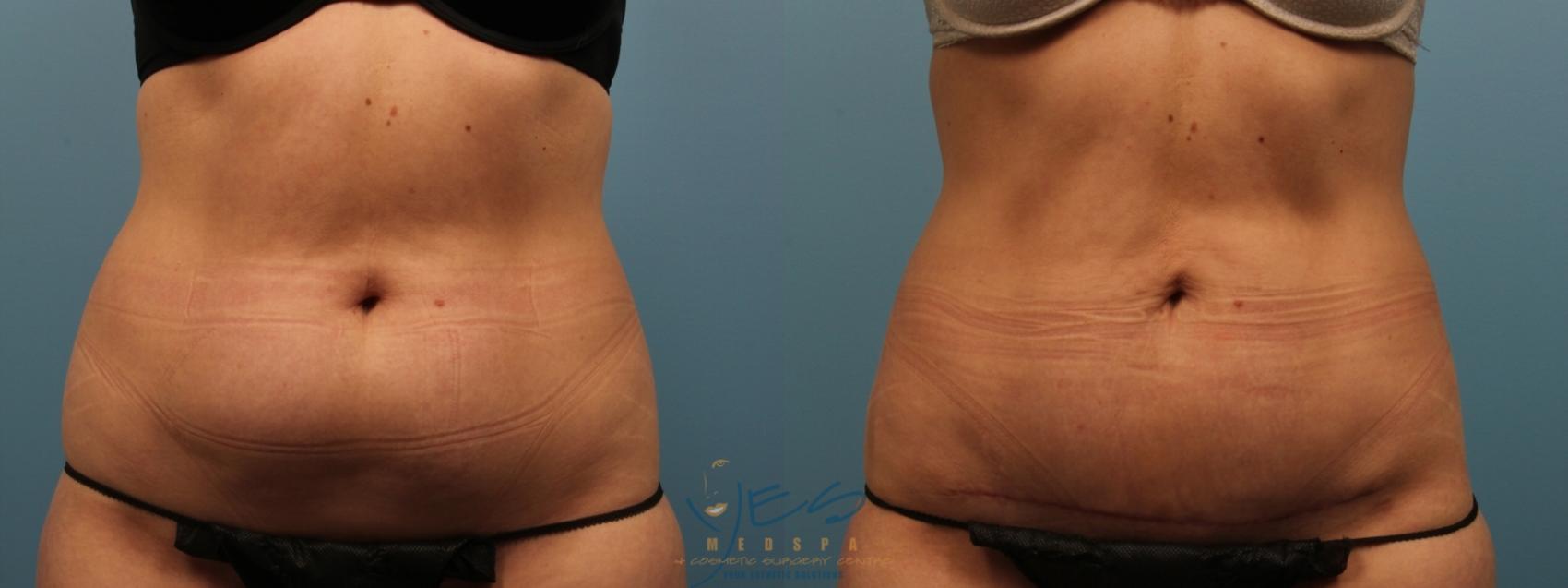 Before & After Tummy Tuck Case 152 Front View in Vancouver, BC